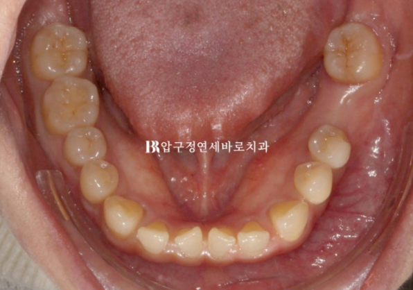 Can Gaps Between the Front Teeth Be Treated with No-Prep Veneers Alone? A Real Case Completed with Gelami After Invisalign Lite image 6