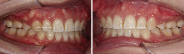 A Review of Extraction Orthodontic Treatment for Protruding Mouth | The Details of Orthodontics That Transform Buccal Corridors and Smile Lines image 9
