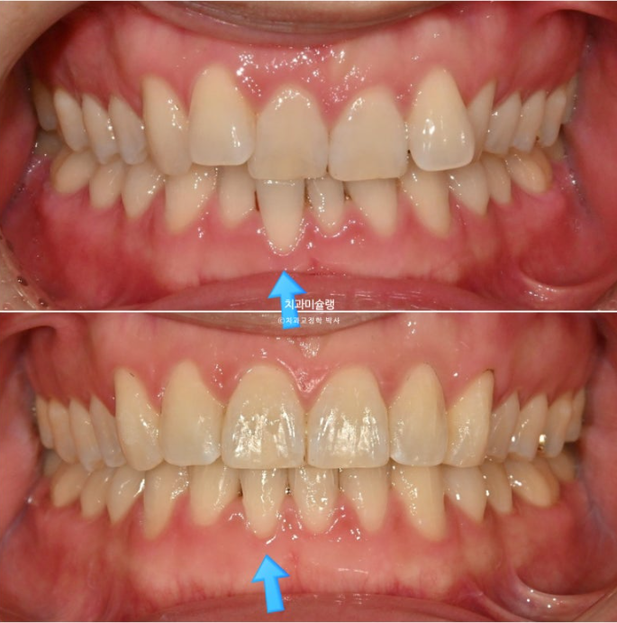 덧니 앞니 부분교정 급속교정 단기 MTA 미니튜브 기간 6개월 관련 이미지 11
