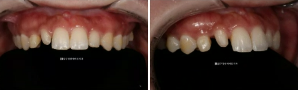 왜소치 치료 잔존유치 무삭제 라미네이트 후기 관련 이미지 8