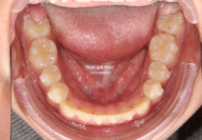 덧니 반대교합 과개교합 인비절라인 퍼스트 악궁확장 어린이 교정 치료 관련 이미지 13