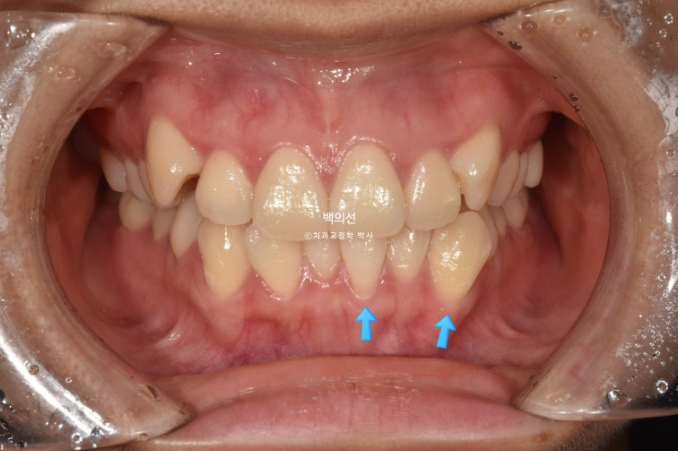 덧니 발치교정 클리피씨 입매 부작용 인중 입술 잇몸 퇴축 관련 이미지 2