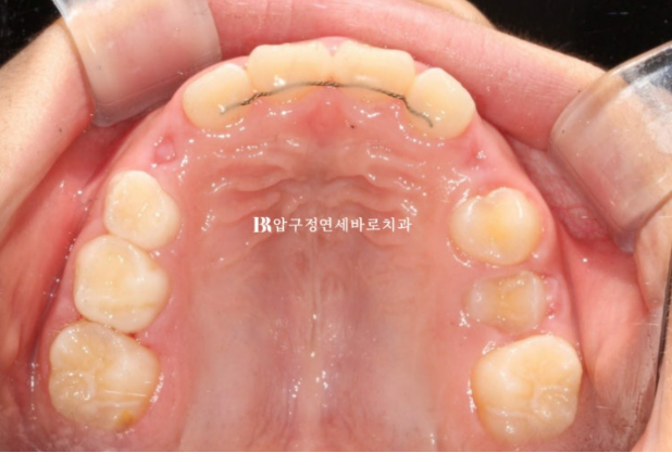 어린이 무턱교정 인비절라인 퍼스트 실제 치료 후기 관련 이미지 18
