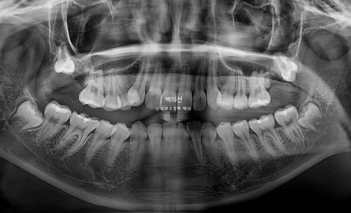 비발치 덧니교정 인비절라인 교정 사랑니 이용 교정 관련 이미지 7