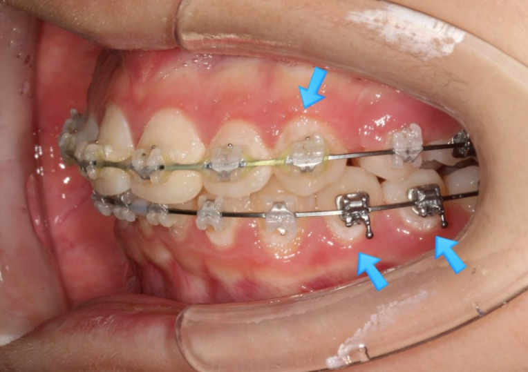 입이 안 다물어짐 입술부전증 호두턱 교정? 관련 이미지 7