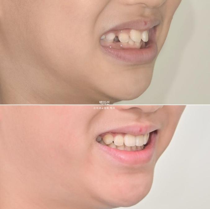 인비절라인퍼스트 어린이 투명교정 과개교합 덧니 악궁확장 돌출 관련 이미지 24