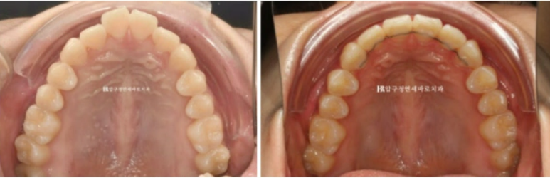 인비절라인 익스프레스 토끼이빨 앞니교정 ? 관련 이미지 13