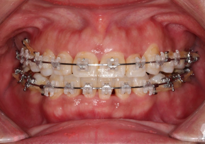 거미스마일 교정 돌출입 발치교정 입술부전 호두턱 치료기간 2년반 관련 이미지 11