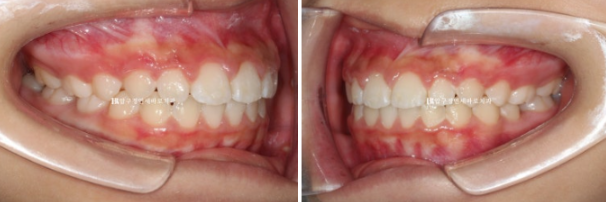 강남 소아교정 인비절라인 퍼스트 어린이 반대교합 관련 이미지 12
