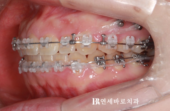 잇몸미소 거미스마일 원인에 따라 다른 치료방법? 관련 이미지 3