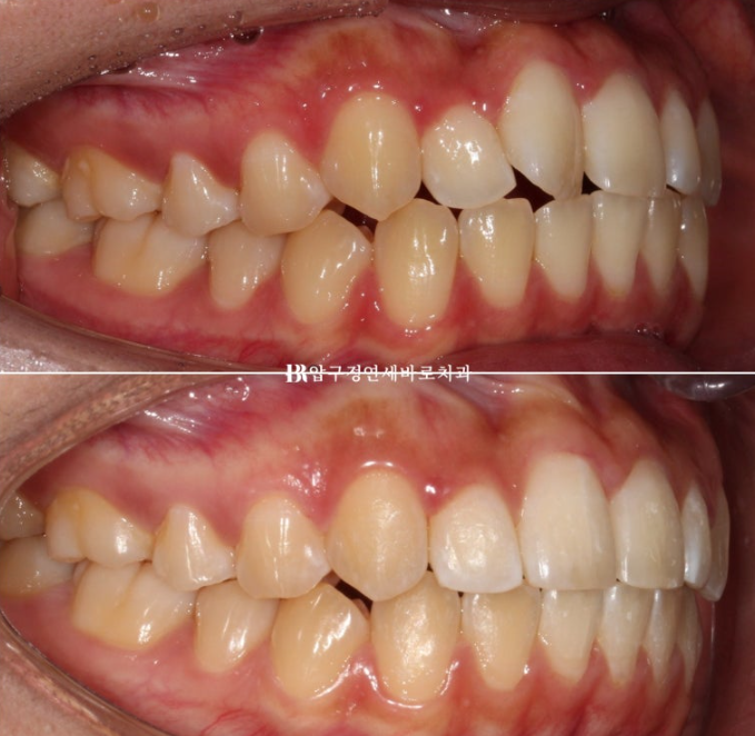 덧니교정 앞니부분교정 치간삭제 후기 관련 이미지 9