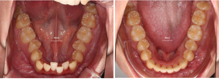 유학생 교정 인비절라인 라이트 치료기간 5개월 관련 이미지 12