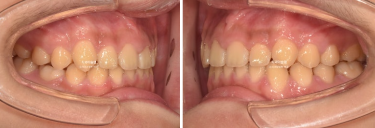 선천적 결손 잔존유치 과개교합 돌출입 인비절라인 퍼스트 어린이 투명교정 치료기간 관련 이미지 15