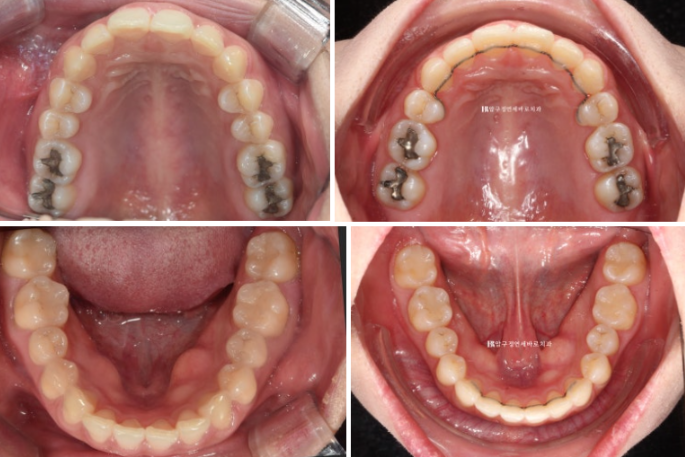 Does Invisalign Prevent Root Movement? Before-and-After Comparison of Extraction Treatment for Protruding Lips image 11