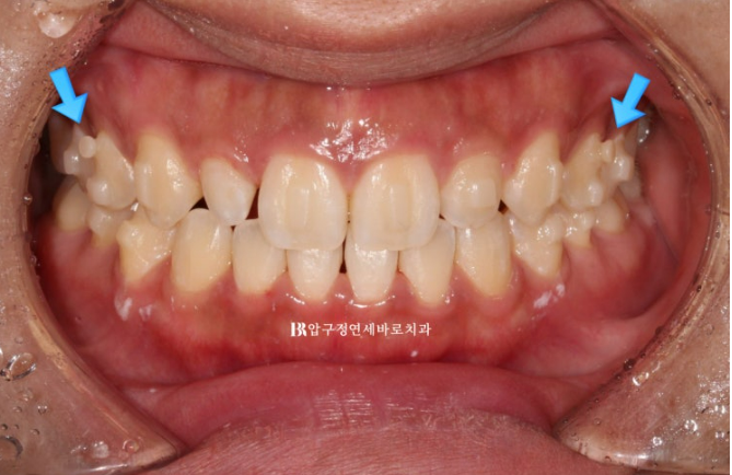 벌어진 앞니, 인비절라인과 무삭제 라미네이트로 자연스럽게 해결 관련 이미지 5