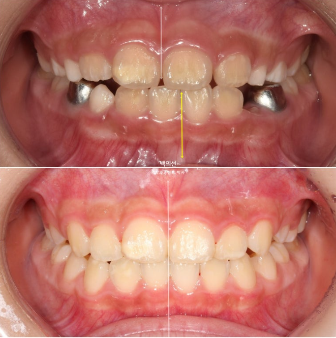 소아 비대칭 교정 인비절라인 퍼스트 재제작 1회 MA 치료 관련 이미지 2