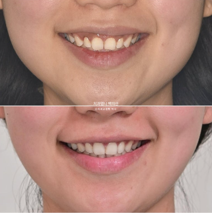 과개교합 옥니 거미스마일 교정 인비절라인 라이트 잇몸성형 후기 관련 이미지 18