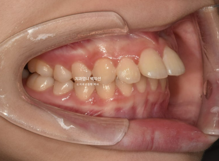 입이 안 다물어짐 입술부전증 호두턱 교정? 관련 이미지 3