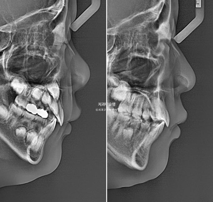 어린이 돌출입 교정 무턱 투명교정 인비절라인 퍼스트 관련 이미지 27