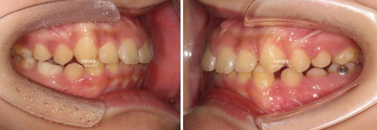 선천적 결손 잔존유치 과개교합 돌출입 인비절라인 퍼스트 어린이 투명교정 치료기간 관련 이미지 12