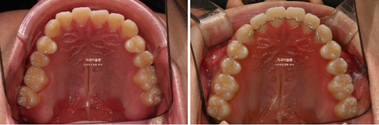 비수술 비발치 주걱턱 절충치료 클리피씨 개방교합 반대교합 치료 관련 이미지 12