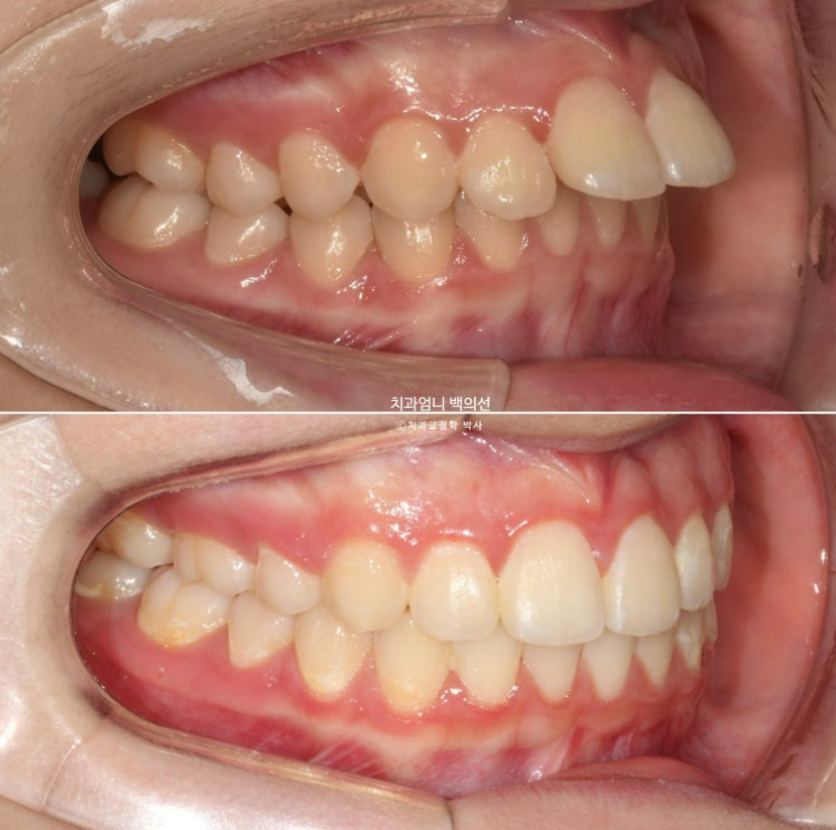 입이 안 다물어짐 입술부전증 호두턱 교정? 관련 이미지 1