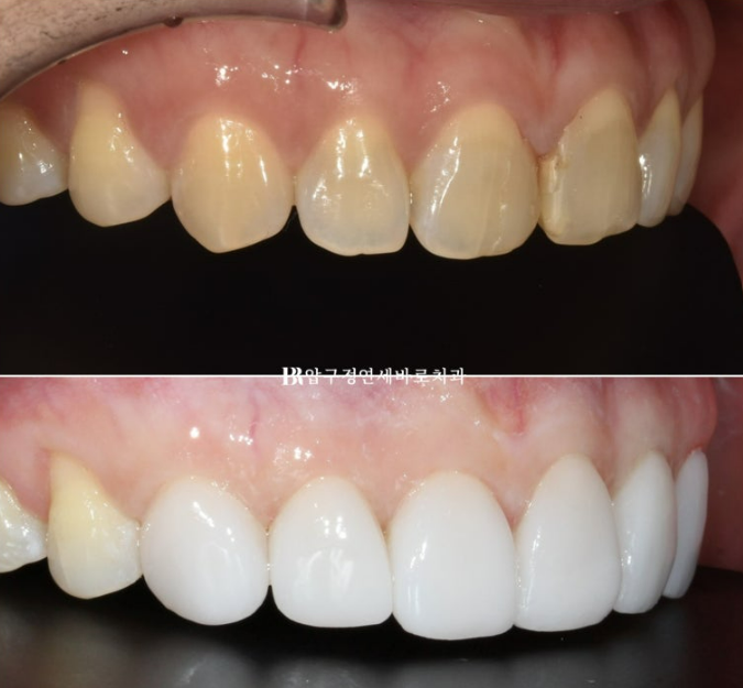 벌어진 치아 교정 인비절라인 라이트 무삭제 라미네이트 치료 관련 이미지 22