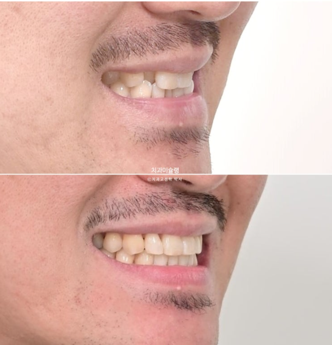 30대 MSE 악궁확장 덧니 반대교합 비발치 클리피씨 부작용 관련 이미지 19