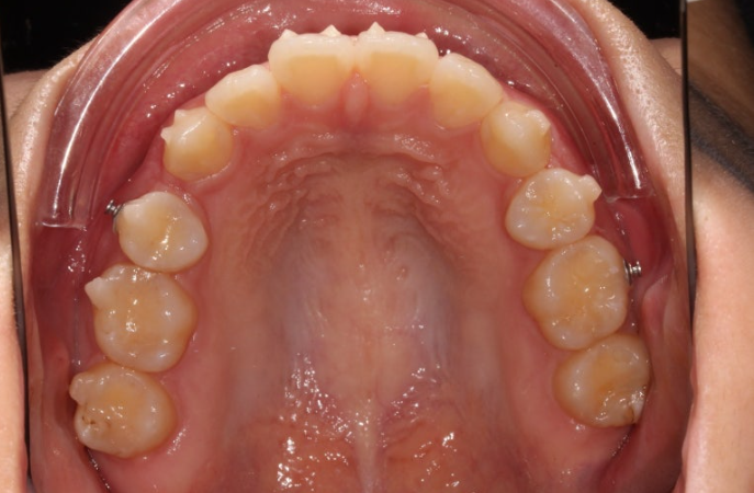 돌출입 교정 인비절라인 발치 교정 개방교합 치료 후기 관련 이미지 9