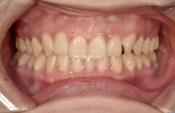 옥니 교정 인비절라인 라이트 옹니 덧니 치료기간 ? 관련 이미지 2