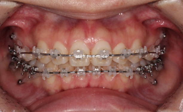 Gummy Smile Correction Review | Natural Improvement of Gummy Smile and Buccal Corridors Through Extraction Treatment for Protruding Teeth image 5
