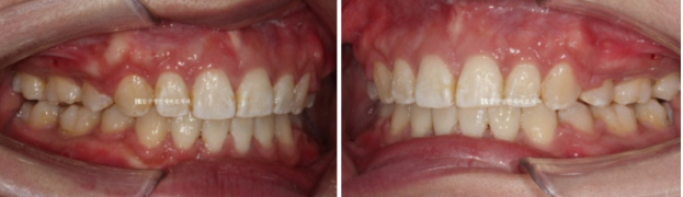 돌출입 교정 입동굴 클리피씨 교정 후기 관련 이미지 10