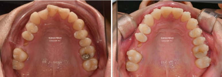 40대 인비절라인 라이트 과개교합 과잉치 덧니 교정 임플란트 보철 교정 후기 관련 이미지 14