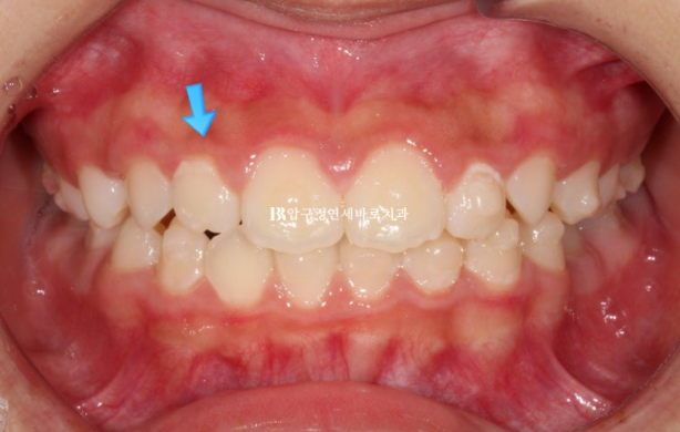 A Child’s Protruding Teeth Correction Review: Difficulty Closing the Lips image 9