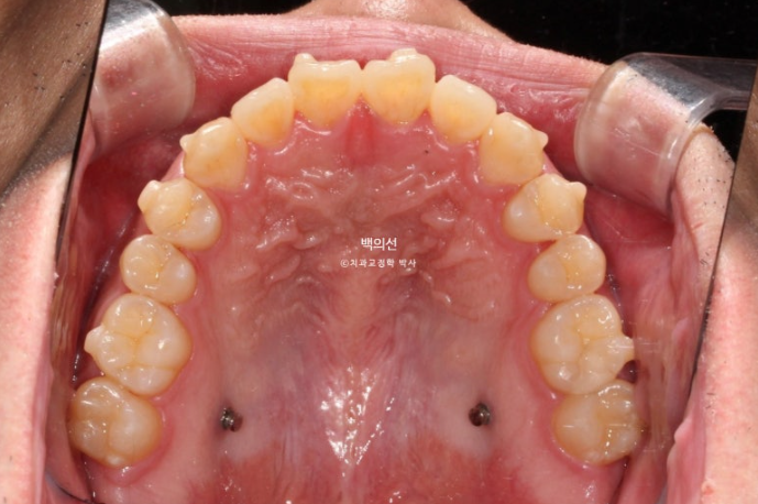 가위교합 나비치아 미니스크류 덧니 교정 인비절라인 라이트 관련 이미지 13