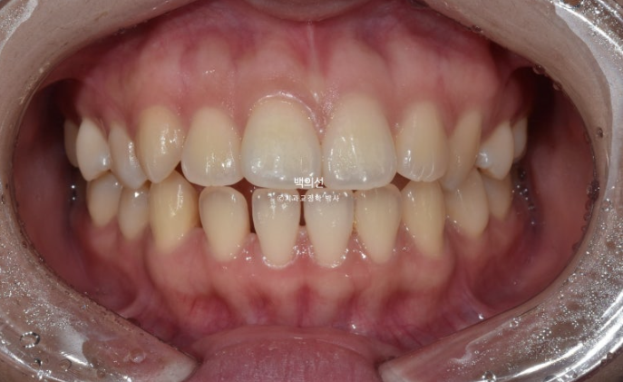 돌출입 교정 인비절라인 발치 교정 개방교합 치료 후기 관련 이미지 2