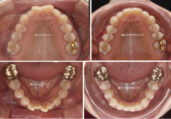 50s Invisalign Lite No-Prep Laminate Bunny Teeth image 10