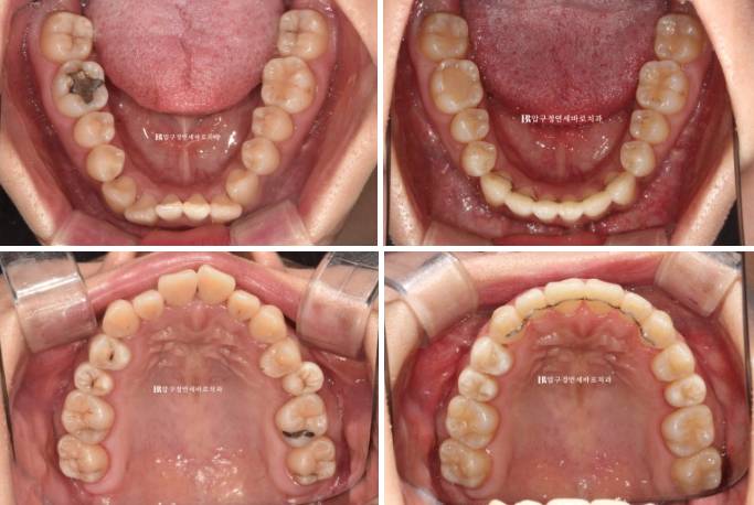 Is compliance important for Invisalign? | A real case that improved reverse bite and scissors bite in 8 months image 12