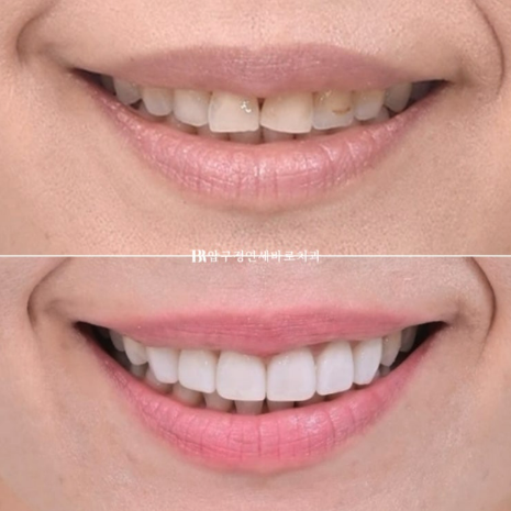 Laminate Veneers in Your 50s: Is It Possible Without Shaving Down the Teeth? | No-Prep Laminate Veneers + Real Case of Front Tooth Partial Orthodontics image 12
