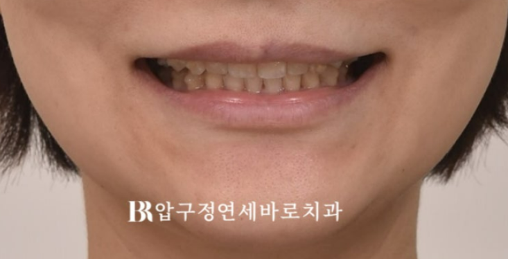 인비절라인 캔팅 교정 과개교합 교정 임플란트 재교정 관련 이미지 5