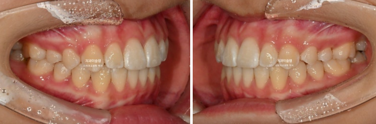돌출입 비발치 어린이 교정 입술부전증 호두주름 호두턱 토끼이빨 인비절라인퍼스트 관련 이미지 15