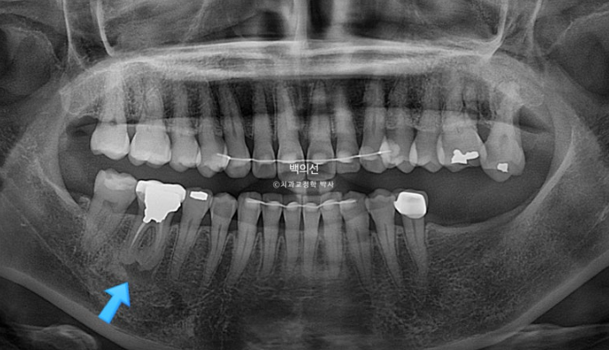 40대 인비절라인 라이트 앞니 돌출 과개교합 덧니 교정 후기 관련 이미지 21