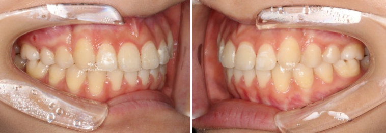 비발치 덧니교정 인비절라인 교정 사랑니 이용 교정 관련 이미지 14