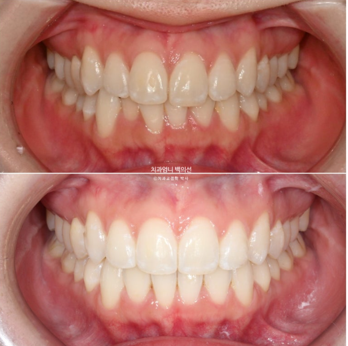 인비절라인 라이트 교정 앞니돌출 과개교합 덧니 교정 관련 이미지 9