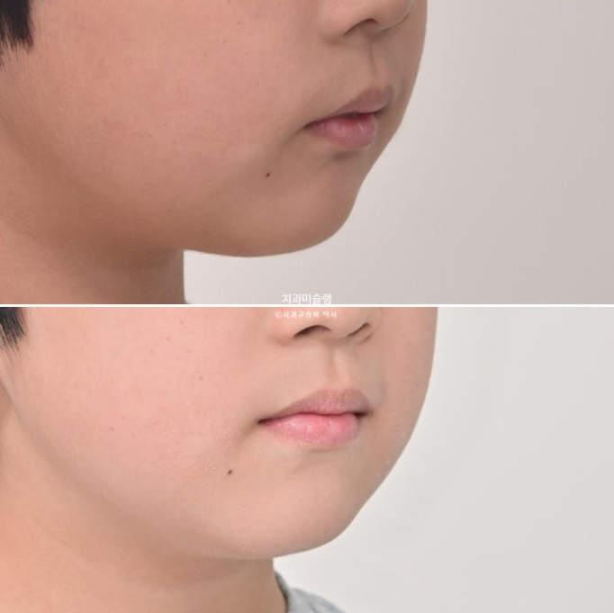 어린이 돌출입 교정 무턱 투명교정 인비절라인 퍼스트 관련 이미지 24