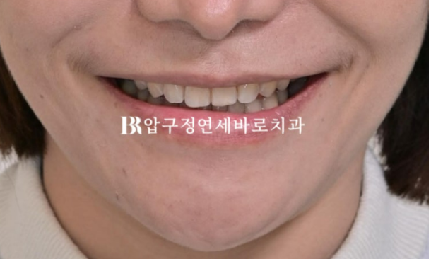 벌어진 앞니, 바로 라미네이트 하지 않은 이유｜인비절라인 후 무삭제 라미네이트 실제 사례 관련 이미지 16