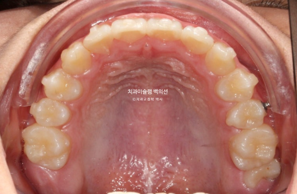 덧니 반대교합 과개교합 인비절라인 퍼스트 악궁확장 어린이 교정 관련 이미지 11