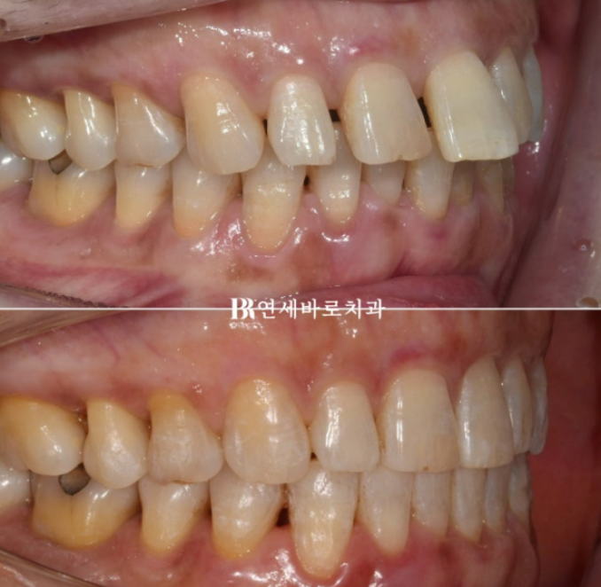 50대 60대 중년 치아 벌어짐 단기 교정 해결하기 관련 이미지 4