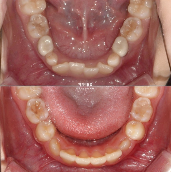 어린이 투명교정 인비절라인 퍼스트 과개교합 교정 후기 관련 이미지 22
