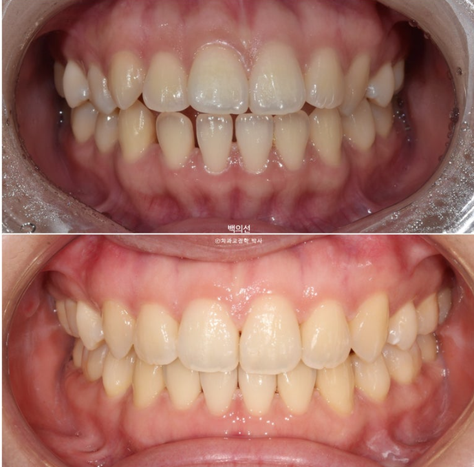 돌출입 교정 인비절라인 발치 교정 개방교합 치료 후기 관련 이미지 22